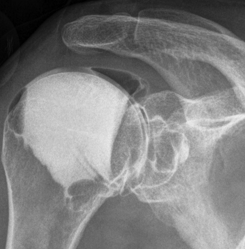 Arthrogram Intact RC